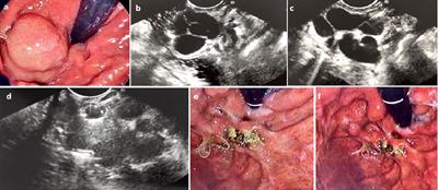 Endoscopic ultrasound guided therapy of gastric varices: Initial experience in the Arab world (with video)